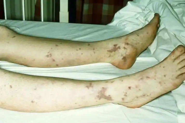 发生融合,周围皮肤颜色正常,红点压之不会褪色,患者可无明显自觉症状