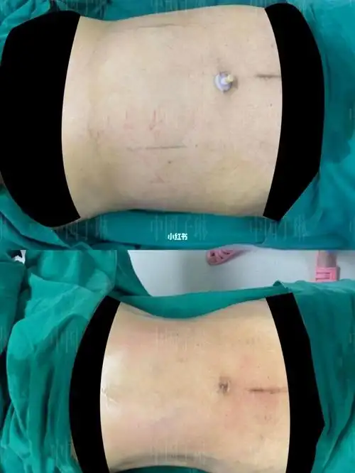 威塑腰腹环吸_腰腹_环吸_吸脂_生育_减肥_减肥医药