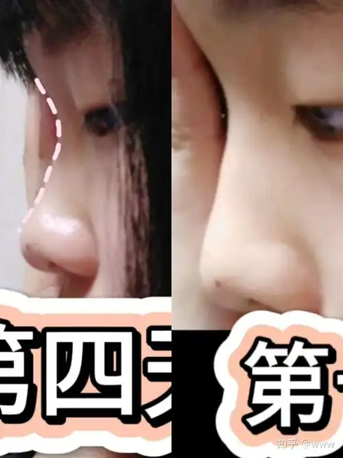 塌鼻子真的可以逆袭嘛