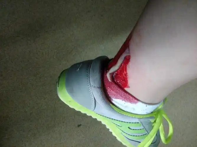 玻璃割到的 伤口很大 温度低好得快 还是温度高好得快