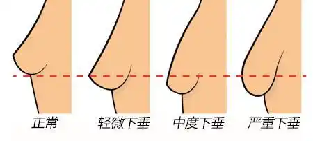 胸下垂都"治"不好,看着男人被拐跑!