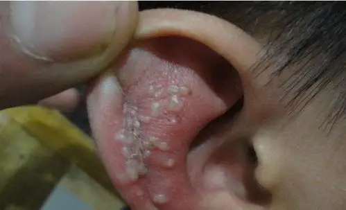 外耳道炎湿疹耳朵长包疼痛听不见流脓水红肿