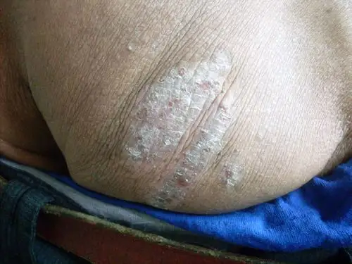 这是什么病湿疹神经性皮炎怎么治疗