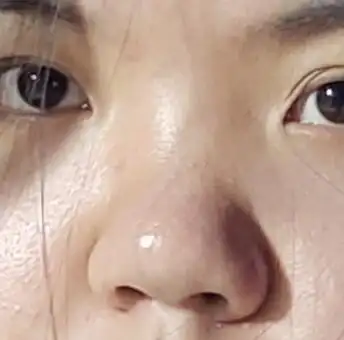 大鼻头低鼻梁怎么补救啊