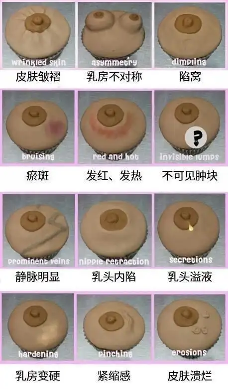 哪些乳头改变(附图)要警惕乳腺癌?