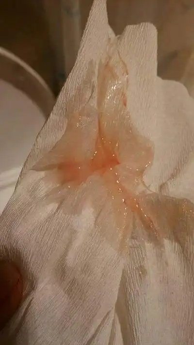 白带有血丝图片44