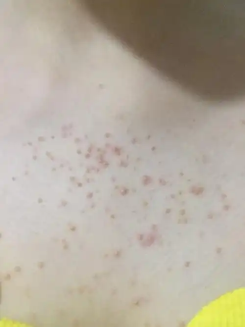 胸前起了一片类似粉刺的小红痘痘,里面像是有白头之类的东西,,_毛囊炎