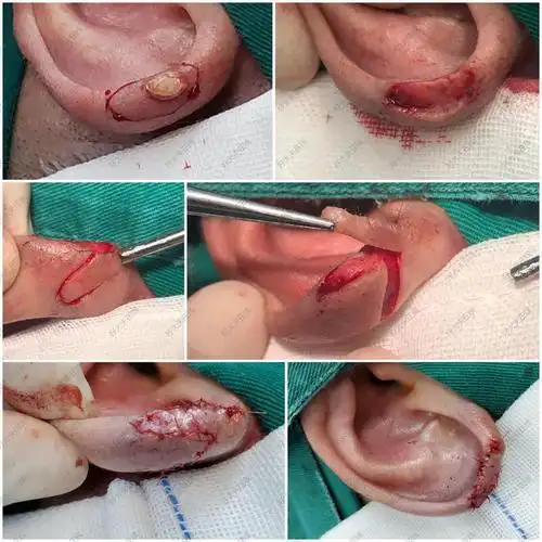 耳廓小肿物1_体表肿瘤 - 好大夫在线