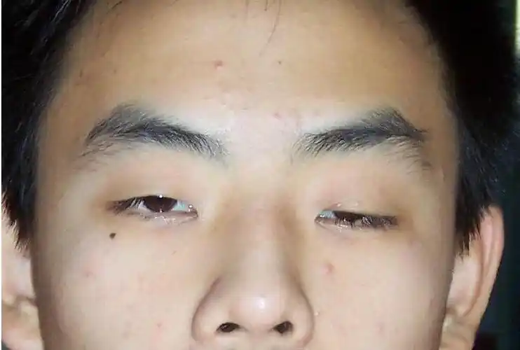 眼科重症肌无力_治疗_症状_鉴别_眼科重症肌无力专家免费咨询_快速问