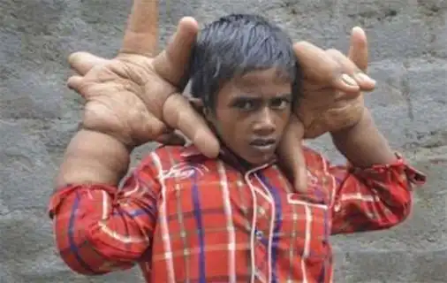 世界上最大的手 巨指病人刘华左手拇指测量长达_谋历史网