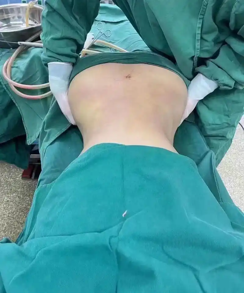 腰腹环吸74妈妈臀#恢复期 - 抖音