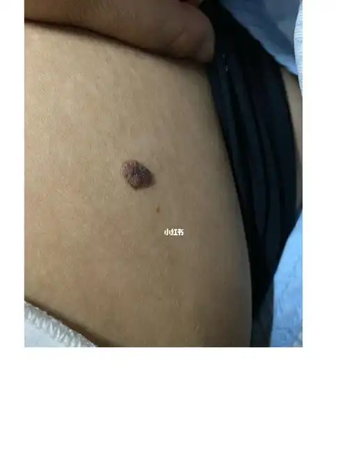 肚子上从小一颗痣,必须要割吗?_美妆_医美_整容_美妆_医美整形