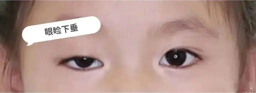 重症肌无力不可怕!花季少女全身乏力1年余,眼睑下垂基本消失!