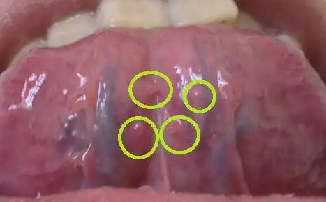 女性外阴尖锐湿疣图的介绍
