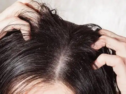 头皮瘙痒难忍,用手指一抓全都是"白泥"?几种迹象都不正常
