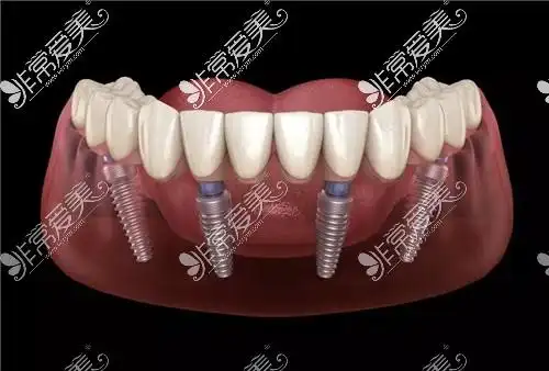 上海全口种植牙的费用和半口牙齿种植价格公布收费很合理