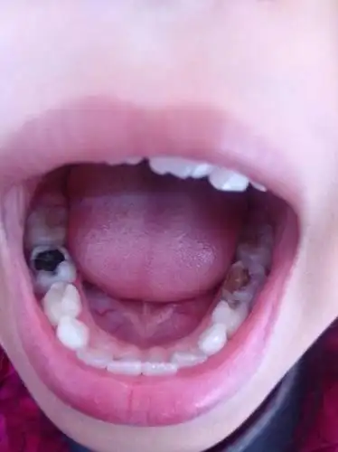 女儿七岁,蛀牙这样严重,有什么办法缓解吗