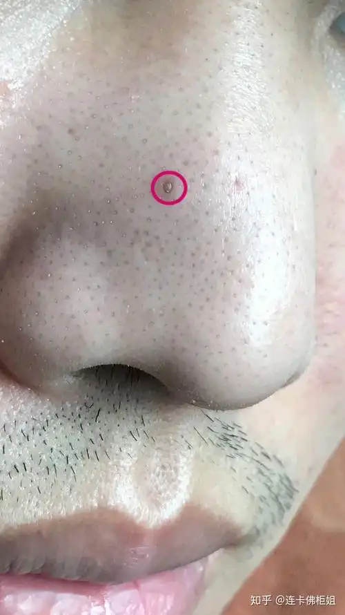 请问鼻子上这种大黑头该怎么处理