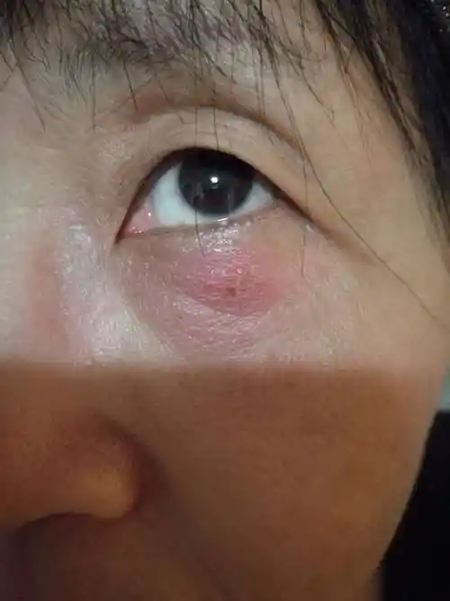林医生您好我妈妈三天前早上起来发现眼睑下长个东西红肿