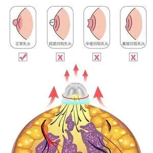 乳头内陷矫正器吸乳头少女凹陷牵引器孕妇隐形拔奶头短小固定夹.