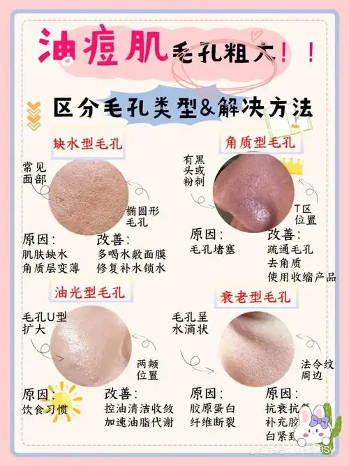 油痘肌毛孔粗大怎么样可以改善呢