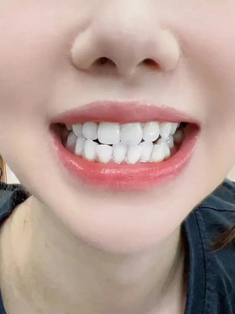 一口干净的牙齿,让你的笑容自信又迷人!