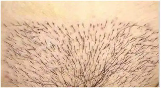 阴毛很直正常吗