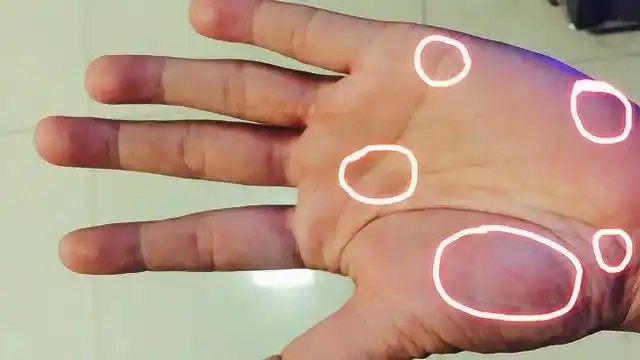 警惕!手掌上多处出现这个,当心肝癌!