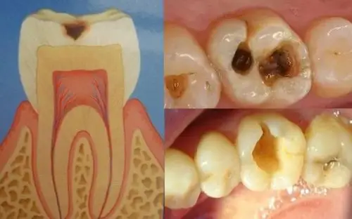 为什么牙齿不疼医生却让我做根管治疗