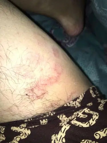 裆部长了一圈一圈的斑,有时好痒.有的还很粗燥.怎么治疗用什么药.