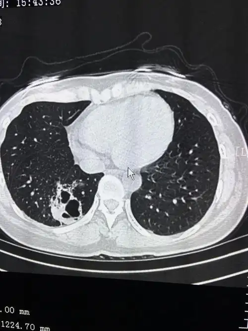 肺隔离症知识点精萃