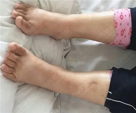 发表了博文《16岁肾病综合征小患者来静康21天消肿20斤》 来自山西的