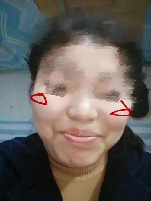 我这是颧骨高还是颧骨宽还是又高又宽是属于大饼脸吗还是大宽脸适合