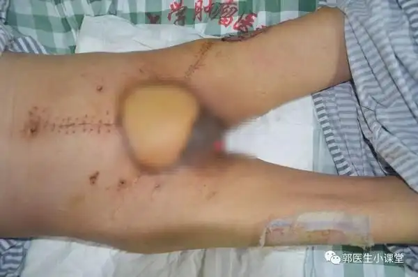 以后只能蹲著尿 「包茎」诱发阴茎癌惹祸