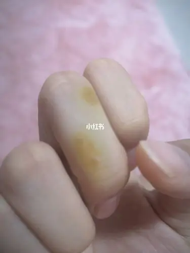 快速治疗扁平疣方法2实验结果