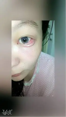 眼睛下面长了东西,已经三天了,又痒又疼,下眼袋肿了,发青,需要去