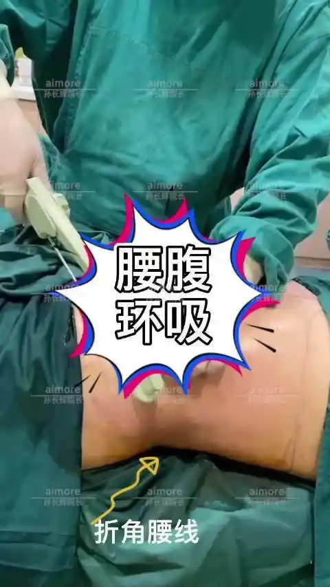 吸脂医生孙长辉超话腰腹环吸去除妈妈臀,塑型出折角腰线,再配合黄金