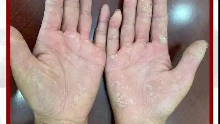 手癣的症状图片