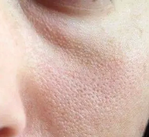 毛孔粗大正常吗