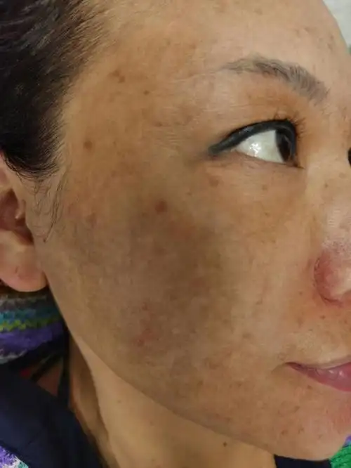 我们刚刚到的小姐姐,治疗严重性的黄褐斑雀斑激素脸,皮肤暗黄,毛孔