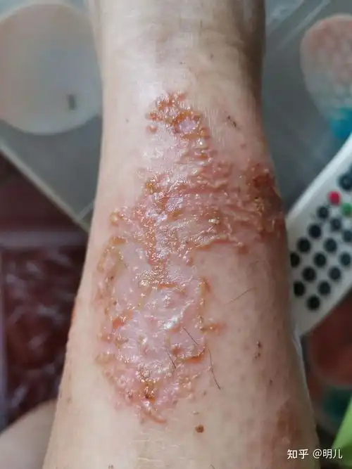 与湿疹的战斗经历