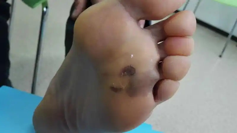 大夫您好我爸今年60岁3年前发现脚底板有黑点在慢慢变