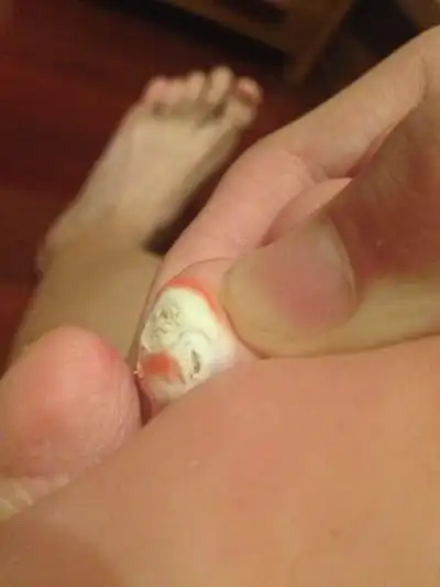 鸡眼根部挖出图片 (9)