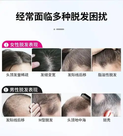 达霏欣米诺地尔搽剂2%男女性防脱发生发液药洗发水正品官方旗舰店