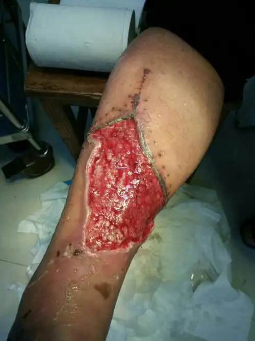 一例小腿后侧皮肤因挫伤严重,出现局部皮肤坏死,缺损的患者