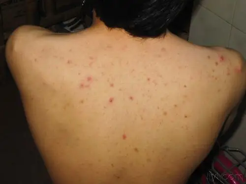 07.22 马拉色菌毛囊炎