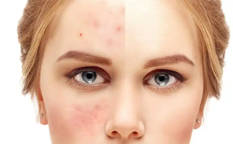 影响面部的血液循环,皮肤自然暗淡无光