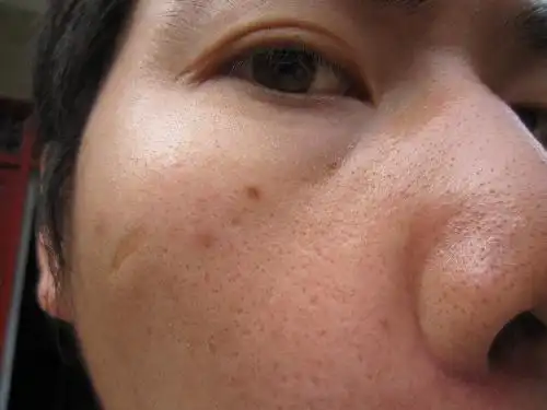 黑头和毛孔粗大 亲爱的你们 对照你们的肌肤看看 谁.