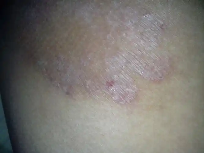 越抓越痒是什么皮肤病_百度知道