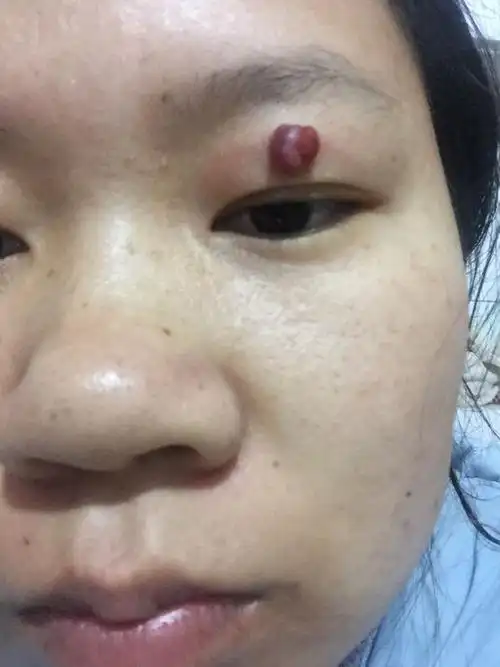 眼皮上的血包越来越大了,太可怕了.